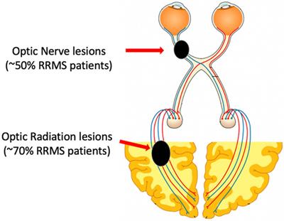 Role of Multifocal Visually Evoked Potential as a Biomarker of Demyelination, Spontaneous Remyelination, and Myelin Repair in Multiple Sclerosis